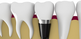 dental implant treatment new delhi
