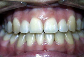 32 Smile Stone Braces used to correct crowded teeth