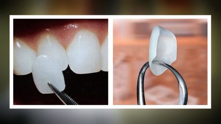 Dental Implants India