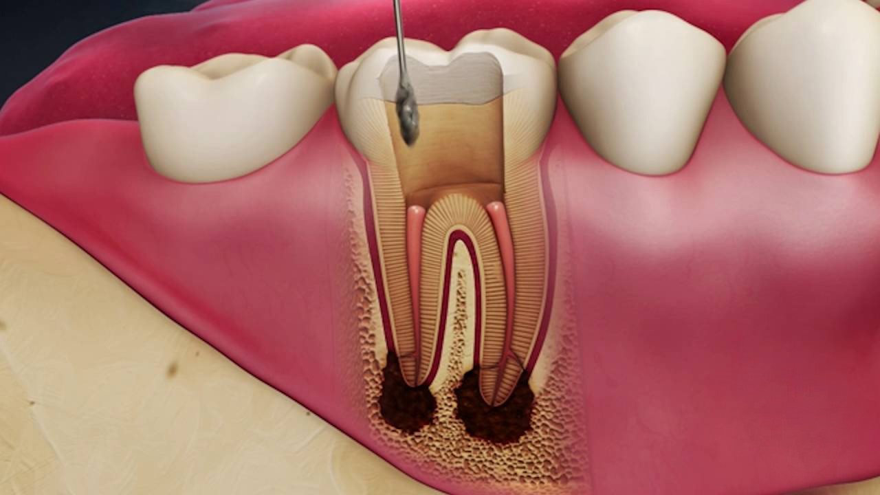 Dental Implants India