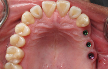 Before Zoom Teeth Whitening