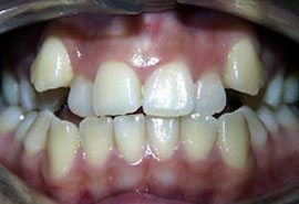 Before Braces to correct crowded teeth
