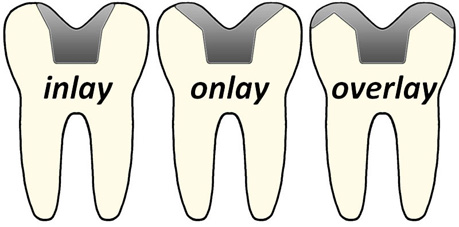 32 Smile Stone Inlays and Onlays