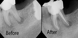 root canal treatment in delhi